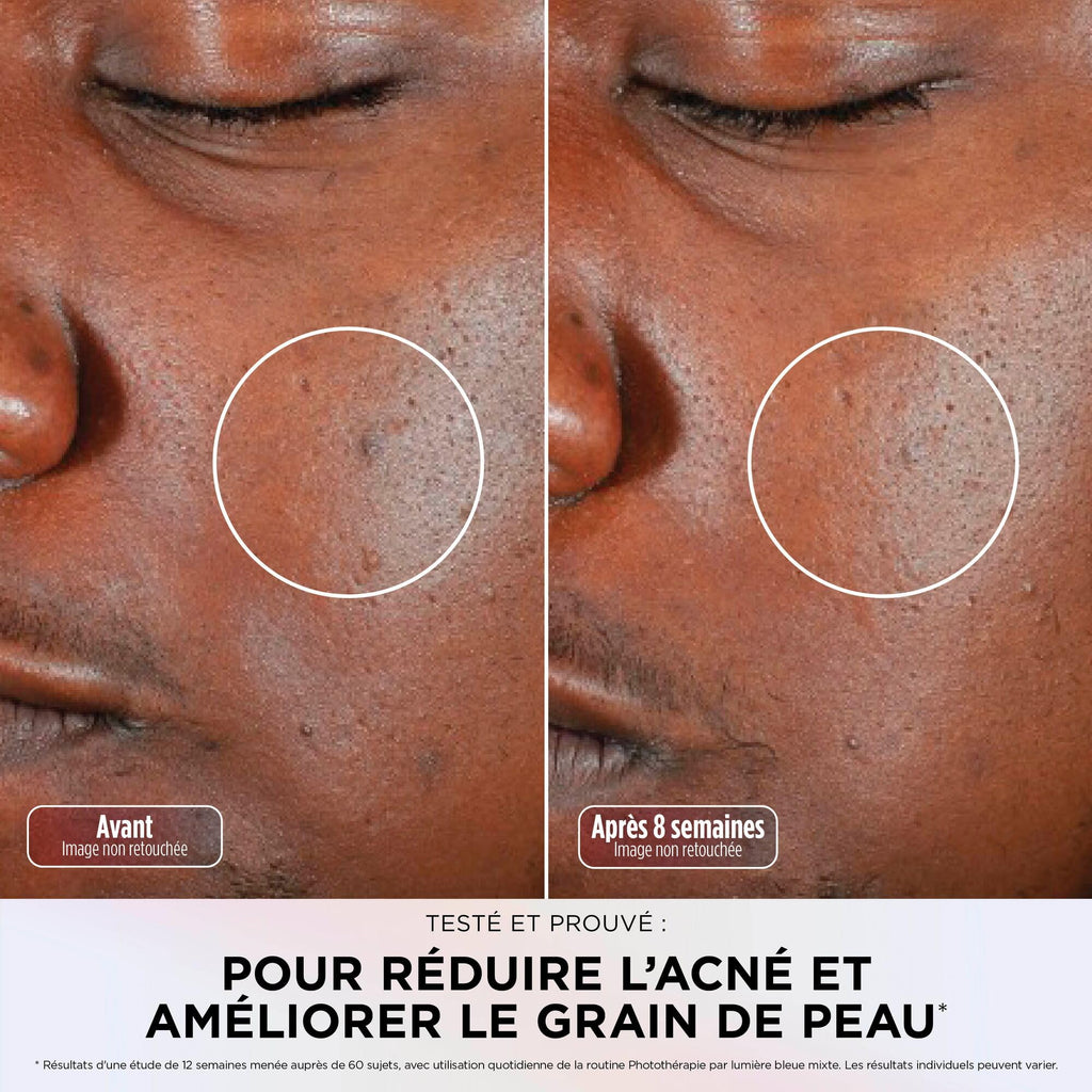 Masque LED Shark CryoGlow avec rafraîchissement du contour des yeux, LED rouge et bleue, Photothérapie par lumière infrarouge, USB-C, Télécommande, Sac de rangement, Sangles réglables